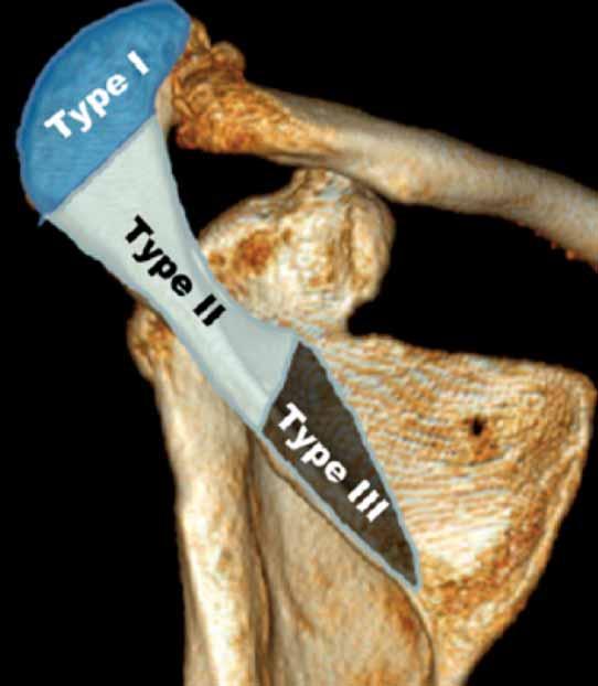 Classification Type I: Acromion Involvement of insertion of a portion of anterior and middle deltoid origin Type II: Scapular spine Involvement of at least the entire middle deltoid origin Type III:
