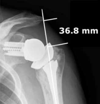 Acromion Fractures & Inverse Prosthesis Detection of Fractures 80% visible on plain films Helpful signs: - Decreasing acromiontuberosity distance normal fracture Ref.