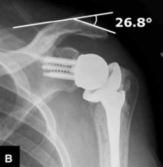 Acromion Fractures & Inverse Prosthesis Detection of Fractures 80% visible on plain films Helpful signs: -