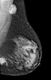 5 Hours Digital Mammography 4.