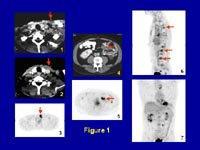 Image 4 is the image from the CT scan showing a mass in the abdomen and this area shows intense activity on the PET scan as seen on image 5.