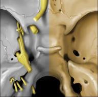 Rare: Cephalocele Hemangiopericytoma Nasal Dermal Sinus DDx Based on Anatomy Central Skull
