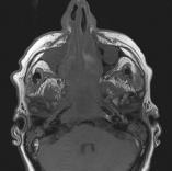expansile, midline, T2 hyperintense Tumor thumbs the pons Diagnosis Case 4 Chordoma Sphenoccipital synchondrosis,