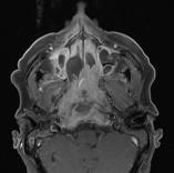 hyperintense Tumor thumbs the pons Salt Lake City courtesy of Eric Ward Case 4 Case 4 DDx: Invasive Central Skull