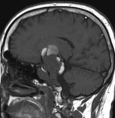 Case 4 DDx: Invasive Pituitary