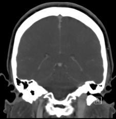 Case 5 Case 5 DDx: Dehiscent jugular bulb DDx: Jugular bulb diverticulum Coronal CT Coronal 3D Post Coronal CT Case 5 Diagnosis Case 5 Diagnosis Jugular Foramen Schwannoma Benign tumor of