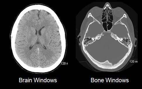 Brain CT scan Brain MRI CT scan gives