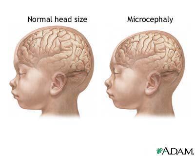 Microcephaly brain development