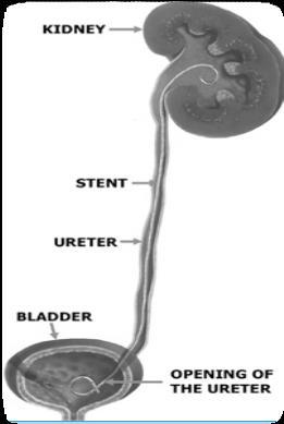 achieved by inserting a ureteric stent to make a channel for the urine to pass into the bladder and allow the kidneys to drain. What is a ureteric stent?