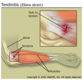 Strain Involve the stretching or tearing of a musculo-tendinous (muscle and tendon) structure Acute strain By a direct blow to the body, overstretching or excessive muscle