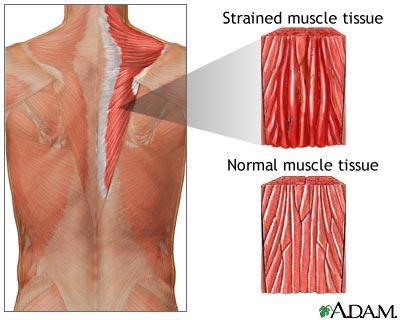Strain Severe Strain - muscle or tendon is partially or completely ruptured, leaving person incapacitated.