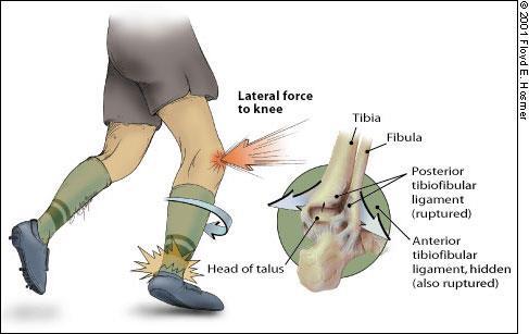 Mechanism of injury high ankle sprain