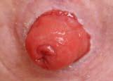 An incision is made in the bowel to allow the passage of faeces through the loop colostomy.