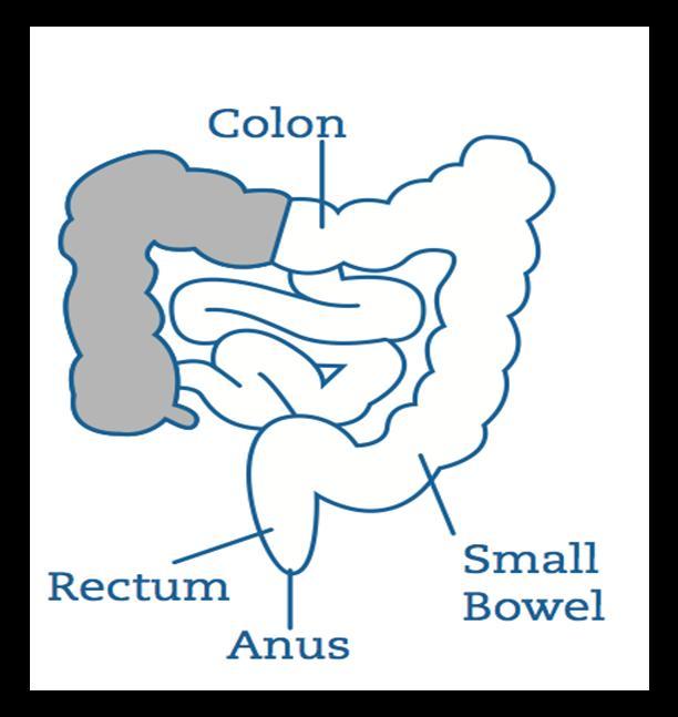 Introduction This leaflet has been designed to help you understand what to expect when you are having a Right Hemicolectomy which is the surgical removal of the right side of your large bowel.