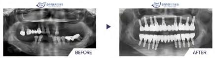 the teeth by implanting an artificial screw to the location where a tooth is lost.