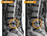 Percutaneous Endoscopic Lumbar Discectomy (PELD) Introduction: It is a cutting-edge treatment method that keeps the lumbar disc tissue and minimizes complications with the insertion of a narrow tube