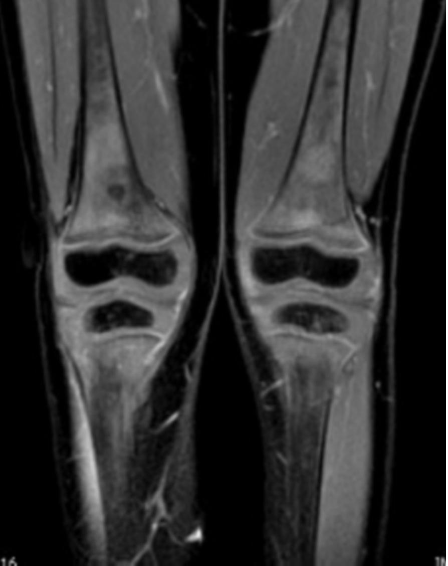 marrow signal in the distal femora and proximal tibiae. B.