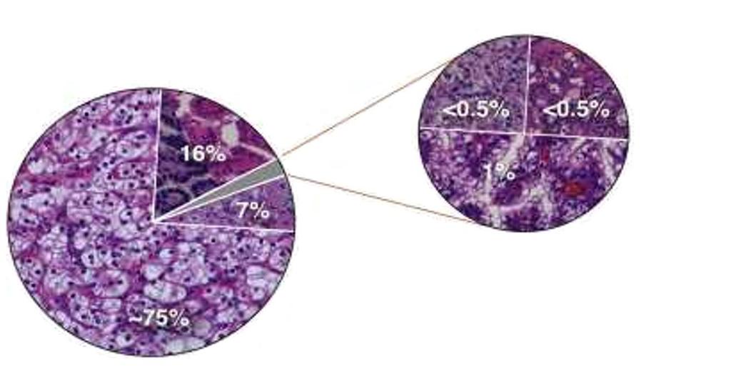 KIDNEY CANCER SUBTYPES Papillary Type 1 and 2 Medullary Collecting duct Chromophobe Translocation Clear cell Reprinted by