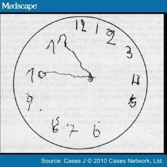 Clock Drawing Test "Without looking at your watch, draw the face of a clock, and mark the hands to show 10 minutes to 11:00.
