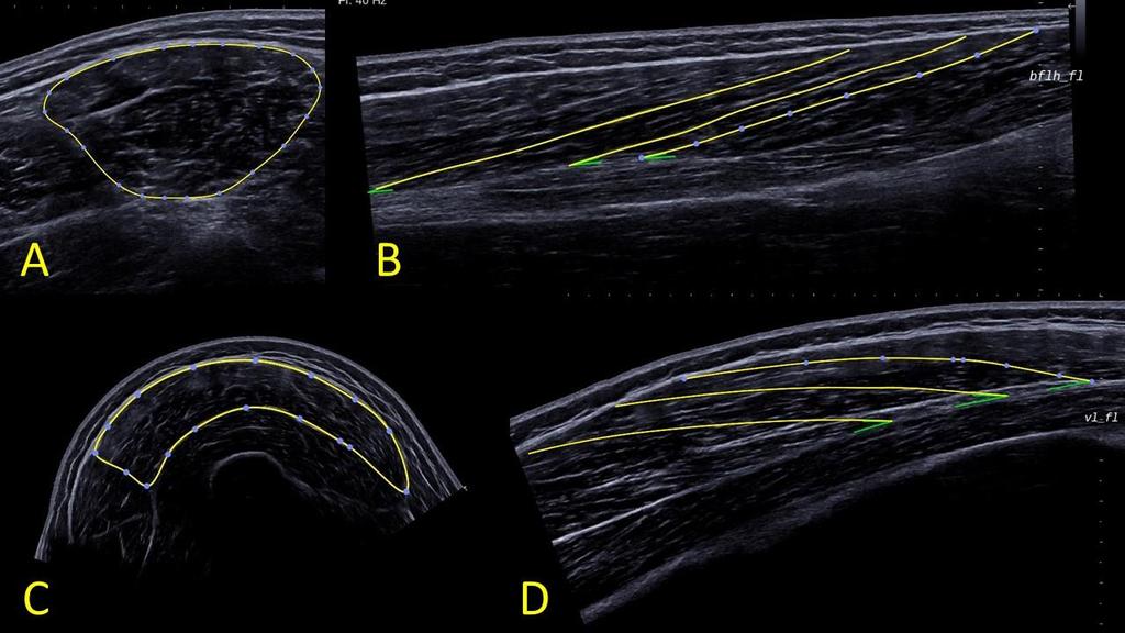 FIGURE 1. A) CSA measurement of the BFLH. B) Muscle fascicle lengths and pennation angles of the BFLH. C) CSA measurement of the VL. D) Muscle fascicle lengths and pennation angles of the VL.