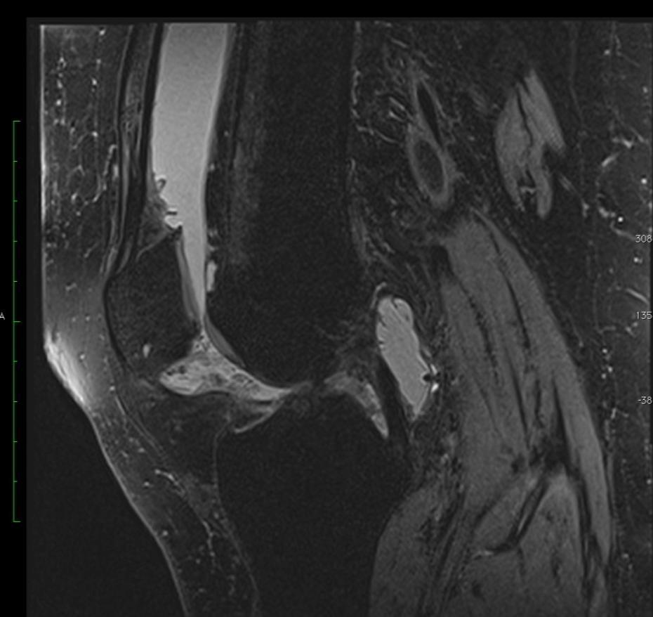 CE-MRI Proton weighted fat