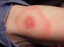 Lyme Disease Lyme disease is a bacterial infection transmitted by tick bites.