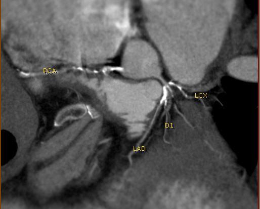 The detection of coronary artery calcification on electron beam computed tomography (EBCT) and its quantitative