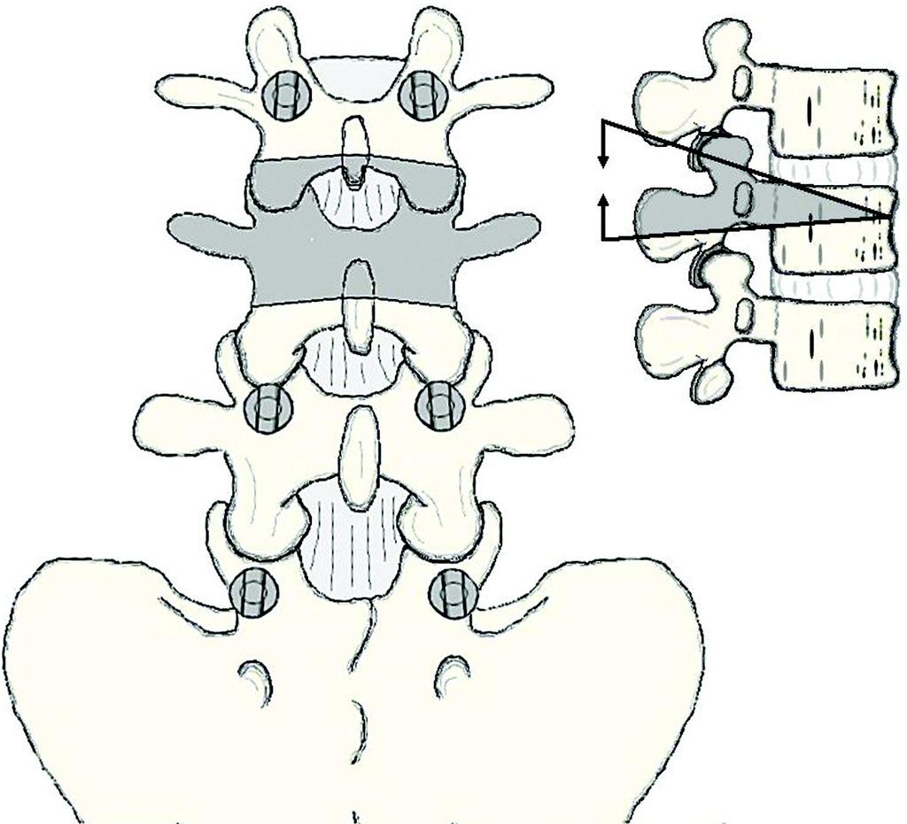 1801 Fig. 5-A Figs. 5-A, 5-B, and 5-C Schematics demonstrating the bone resection pattern for a pedicle subtraction osteotomy. Fig. 5-A The shaded area indicates the site for the osteotomy.