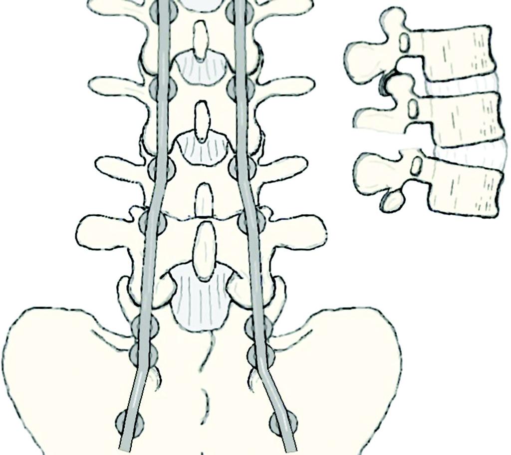 1800 Fig. 4-A Figs. 4-A, 4-B, and 4-C Schematics demonstrating the bone resection pattern for a Smith-Petersen osteotomy. Fig. 4-A The shaded area indicates the site for the osteotomy.