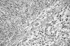 The neoplastic cells had pointed tapering nuclei, abundant pale eosinophilic or amphophilic cytoplasm, and indistinct cell borders. The stroma had a variable amount of collagen.