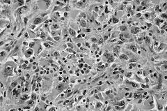giant cells, and distinct curvilinear vessels, in addition to minor solid pleomorphic or Figure 4 Pleomorphic or spindle cells arranged in a storiform pattern with variable inflammatory infiltrate of