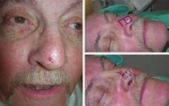choices Figure 5) Basal cell carcinoma