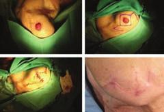 Figure 3) Basal cell carcinoma of the