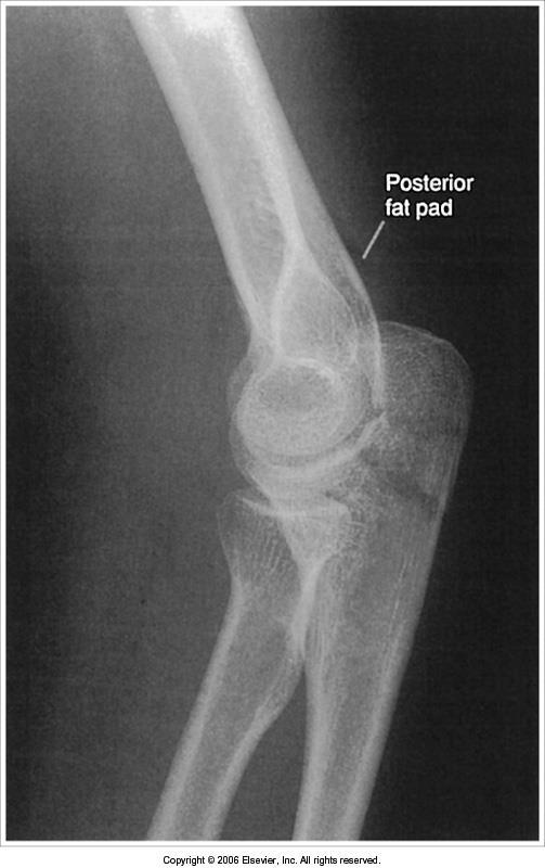 Lateral elbow Error: Elbow.