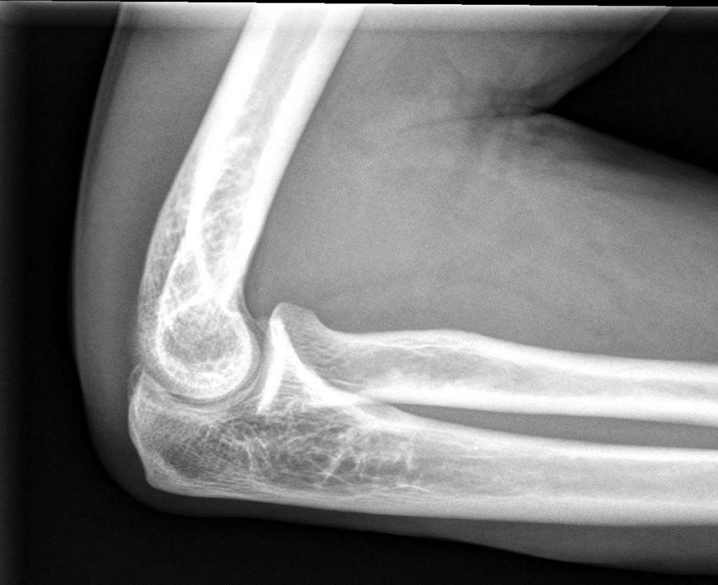 Lateral elbow Error: humerus.