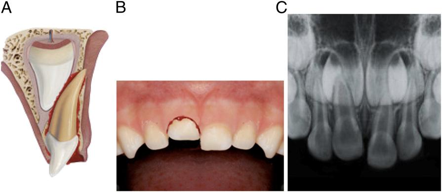 affecting the lips, gingiva, tongue, palate, and severe tooth injury. 12,13 FIGURE 7 Intrusive luxation. FIGURE 8 Avulsion. FIGURE 9 Uncomplicated crown fracture (no pulp exposure).