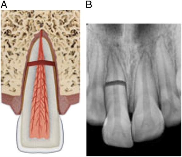 Intrusive Luxation When a primary tooth is intruded, it will typically reerupt without intervention.