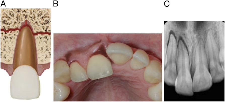 a dentist is indicated for a tooth with a complicated fracture. If the tooth is removed, then a space maintainer may be indicated if the child has an active digit-sucking habit.