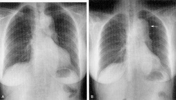 Chest Xray A Baseline study 3 years prior B Aortic knob widened (arrow), proximal aortic