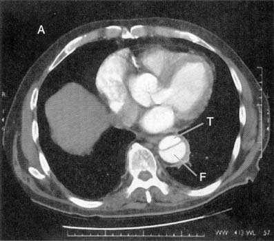 CT of descending aortic dissection Braunwald E et. al.