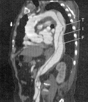 MRI of descending thoracic aortic dissection Braunwald E et. al.
