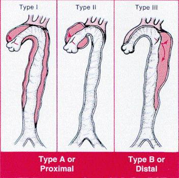 Classification Anatomic Debakey Types 1, 2, 3 Stanford Types A, B Descriptive Proximal, Distal Temporal Acute, <2