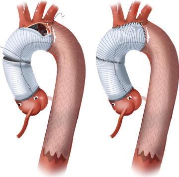 Antegrade Thoracic Stent-Graft Impact on Development of TAAs 78 Type A, DeBakey I dissections at Penn (2005-2008) 42 standard hemiarch, 26 additional descending