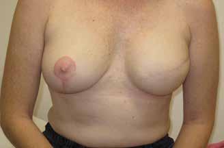 The implant is placed beneath the chest (pectoralis) muscle.
