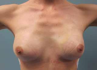 only area that needs to heal is the breast/chest area Disadvantages > It is difficult to reconstruct a very large breast with this technique, unless the reconstruction is combined with a procedure to