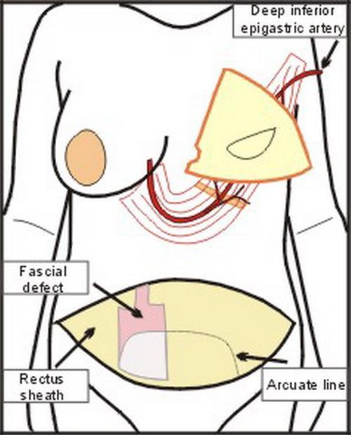 Downloaded from 2. Pedicled TRAM Flap TRAM stands for Transverse Rectus Abdominis Myocutaneous Flap. This flap is taken from the lower abdomen, in the same distribution as a tummy tuck.