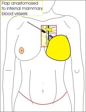 Downloaded from However, new microsurgical options that do not remove any abdominal muscles are now available.