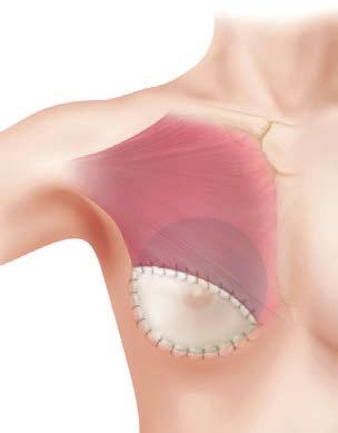 What options are available for breast reconstruction? Various techniques are available for breast reconstruction.