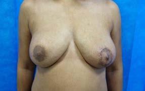 morbidity); fewer postoperative expansions needed to achieve the desired volume; and the inframammary and lateral mammary folds can be redefined.