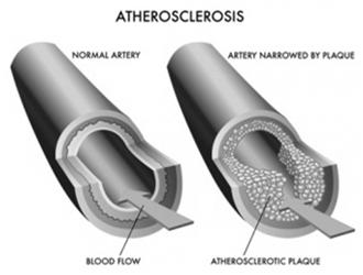 Arteriosclerosis Atherosclerosis the most common type, plaques of fatty
